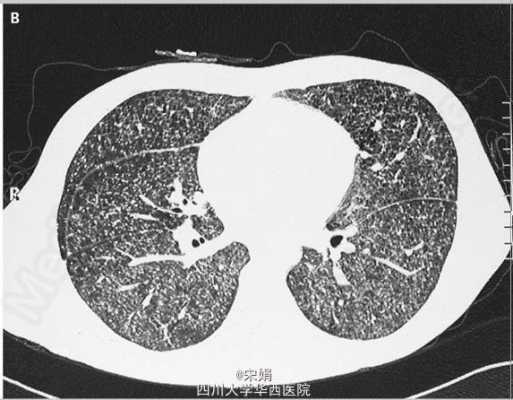 肺栗粒灶是什么东西（肺部有栗粒灶说明了什么?）