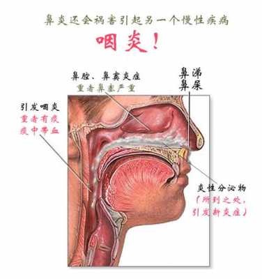  烟炎是什么症状「怎么判断自己是咽炎」