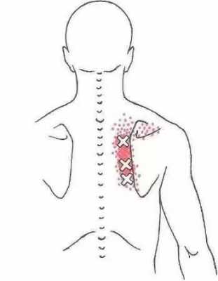  肩胛骨疼痛是什么病「肩胛骨疼是什么原因?」