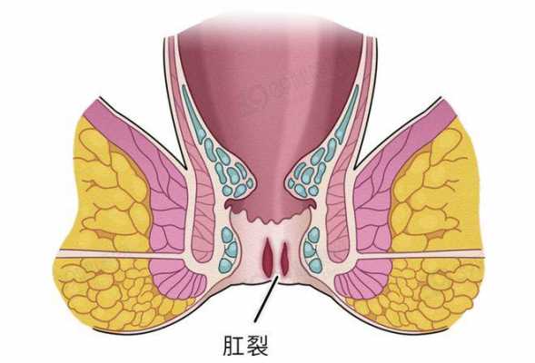 肛周裂口是什么原因引起的_肛周裂口是什么原因引起的女性