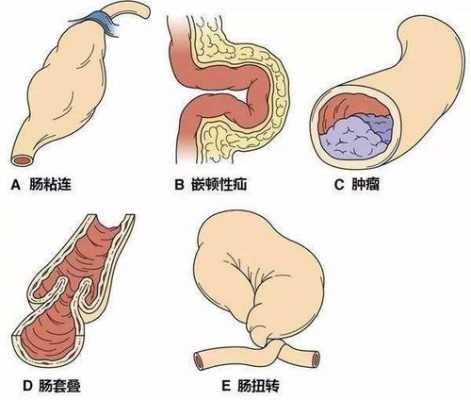  肠阻塞有什么症状「肠梗阻最明显的一个征兆」