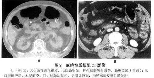  肠阻塞有什么症状「肠梗阻最明显的一个征兆」