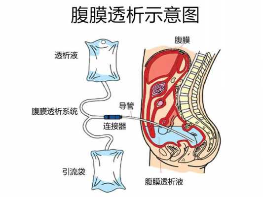 腹透是什么意思_capd和dapd腹透是什么意思