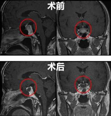 垂体瘤是什么_垂体瘤是什么科室