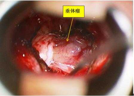 垂体瘤是什么_垂体瘤是什么科室