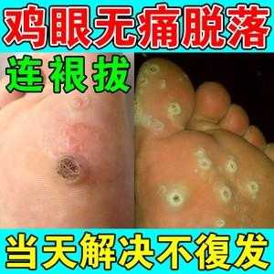 肉刺用什么药能去除,治疗肉刺 