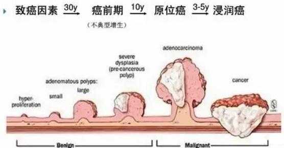  什么是增生性肠息肉「什么是增生性肠息肉怎么预防」