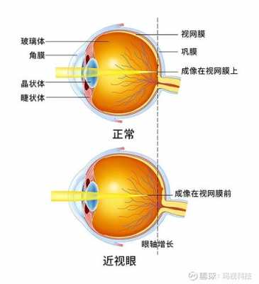 双眼屈光不正是什么意思（双眼屈光不正是什么意思 影响视功能）