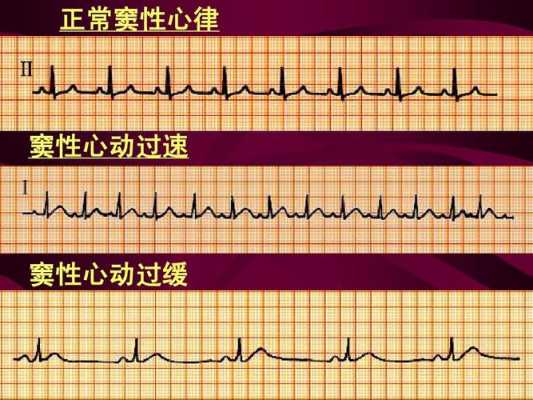 窦性心律是什么（窦性心律是什么情况,严重吗）