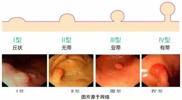 直肠隆起病变是什么_直肠隆起病变是癌症吗