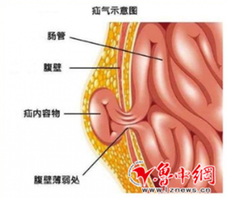 嵌顿疝气是什么意思