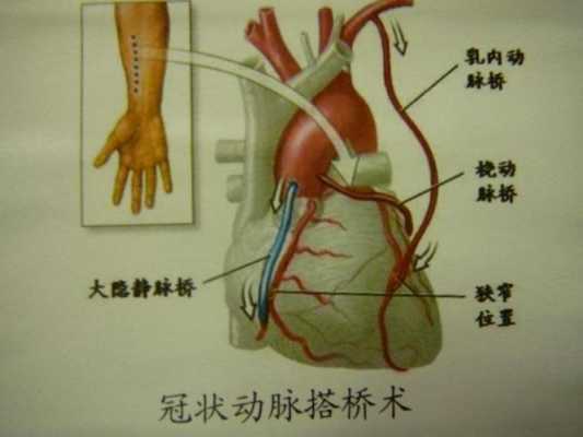 心脏搭桥后最怕什么,心脏搭桥手术费用全部大概要多少 