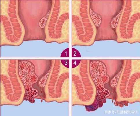 人为什么会有痔疮_人为什么会长痔疮的原因