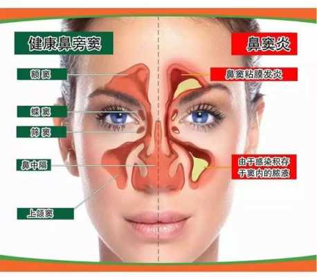 鼻窦炎会引起什么症状,鼻窦炎的最明显五大症状 