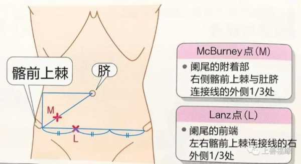 阑尾炎在什么位置图片指一下