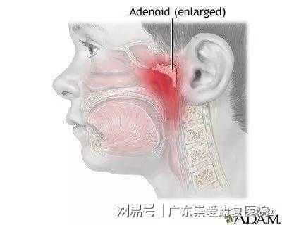 鼻子里面有什么,鼻子里面有什么腺体肿大 