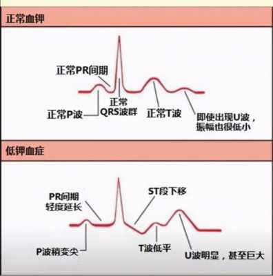 身体缺钾8大征兆