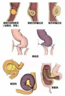 什么原因引起肠梗阻