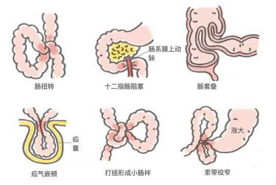 什么原因引起肠梗阻