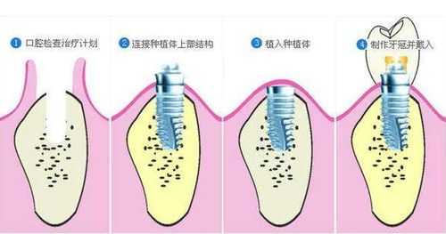 种牙根后注意什么,种完牙根需要注意什么 