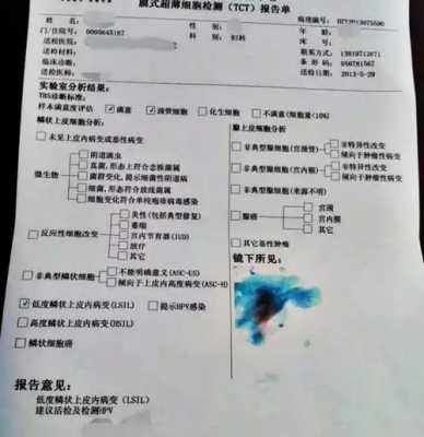 宫颈液基细胞学检查是什么 TCT