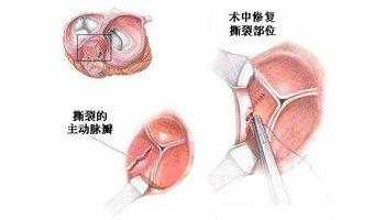 主动脉瓣轻度返流是什么意思（主动脉瓣轻度返流是怎么回事）