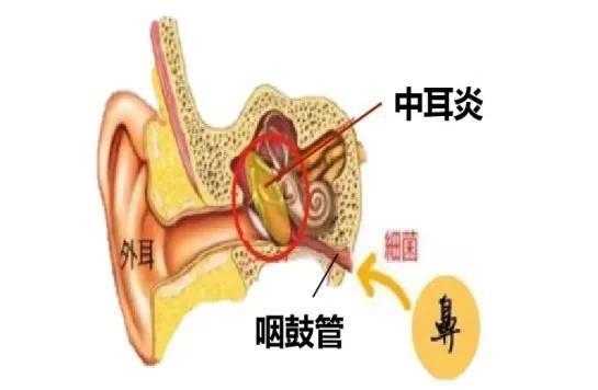 中耳炎是什么意思到底是什么病