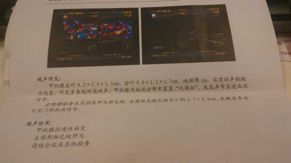 亚临床甲减是什么意思,亚临床甲减是什么意思啊 