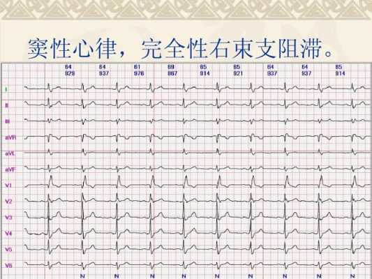  完全性右束支传导阻滞是什么意思「完全性右束支传导阻滞需要治疗吗」