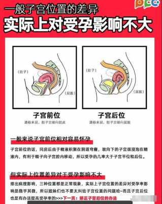 子宫移位是什么原因造成的-子宫前位和子宫后位有什么区别