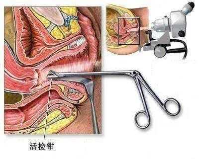 宫颈活检主要检查什么,宫颈活检检查什么病 