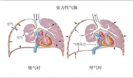 什么叫气胸