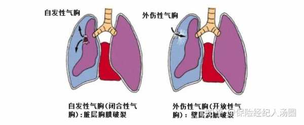 什么叫气胸