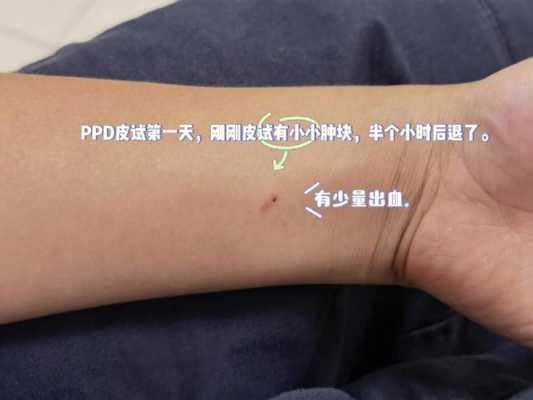  皮试阴性是什么意思「ppd皮试阴性是什么意思」