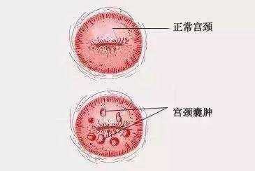 为什么会有宫颈囊肿,女人为什么会宫颈囊肿 