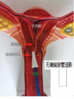 输卵管造影是什么意思_造影第二个月容易怀孕