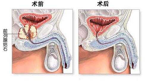 前列腺结石有什么症状_前列腺结石有什么症状和治疗