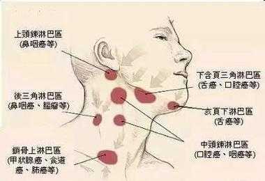  脖子两侧肿大是什么病「脖子两侧肿大是什么病疼是怎么回事」