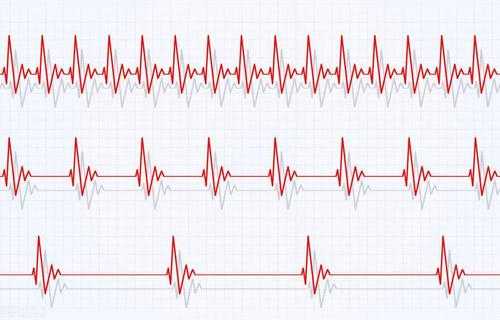 心跳慢什么原因（心电图心跳慢什么原因）