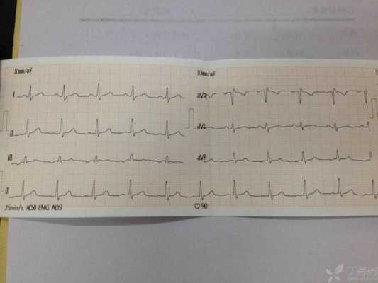 心跳慢什么原因（心电图心跳慢什么原因）
