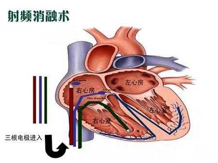 心脏消融术是什么手术,心脏消融术是什么手术有危险吗 