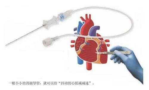 心脏消融术是什么手术,心脏消融术是什么手术有危险吗 