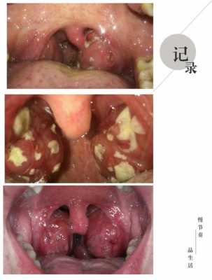 扁桃体化脓是什么引起的（扁桃体化脓越早输液越好吗）