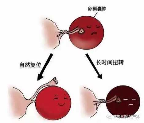 卵巢小囊肿有什么症状（卵巢小囊肿怎么才能消除）