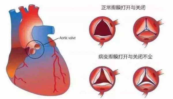 什么是心脏瓣膜病（什么是心脏瓣膜病?谢谢!）