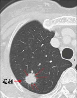 肺结节凹陷是什么意思