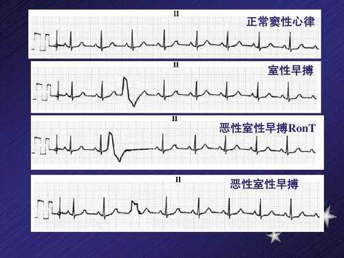 频发交界性早搏是什么意思-交界性早搏是什么意思