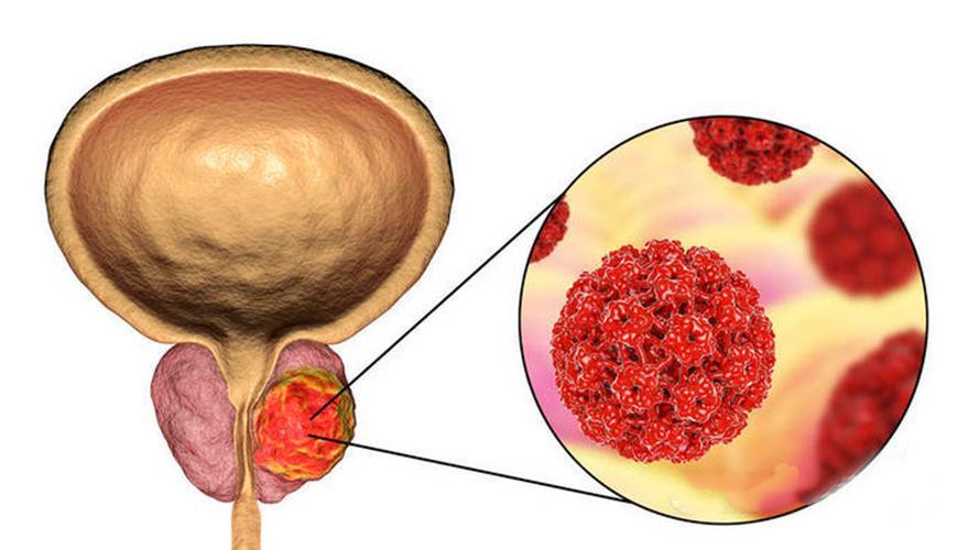 前列腺钙化有什么危害,前列腺钙化有什么危害如何治疗 