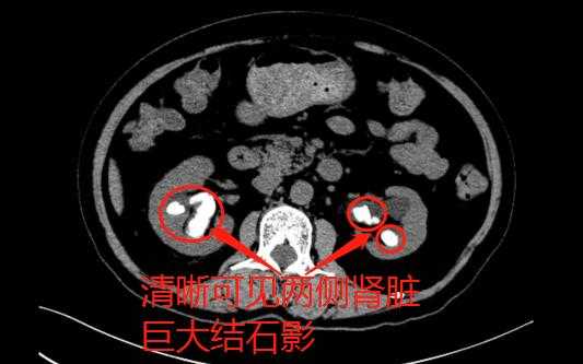 左肾钙化灶是什么意思需要治疗吗