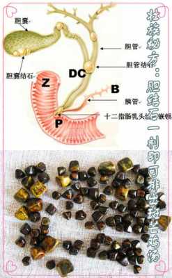 胆囊多发结石是什么意思女性-胆囊多发结石是什么意思